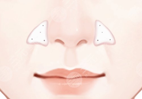 上海九院墊鼻基底費用