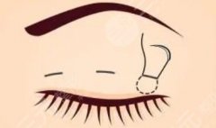 肉條感雙眼皮如何修復(fù)？眼整形失敗必備攻略！