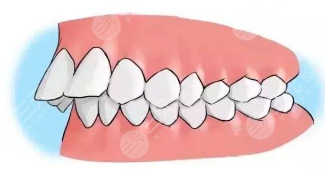 牙齒矯正