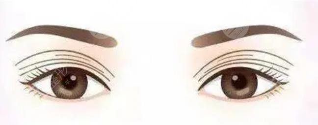 雙眼皮