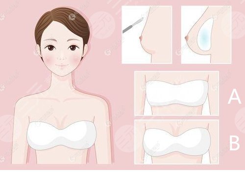 辛敏強(qiáng)隆胸收費價目表