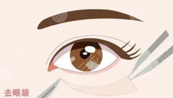 武漢同濟醫(yī)院去眼袋案例