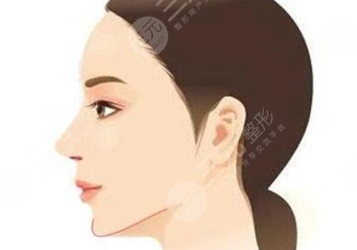 整容下巴需要花費(fèi)多少錢呢