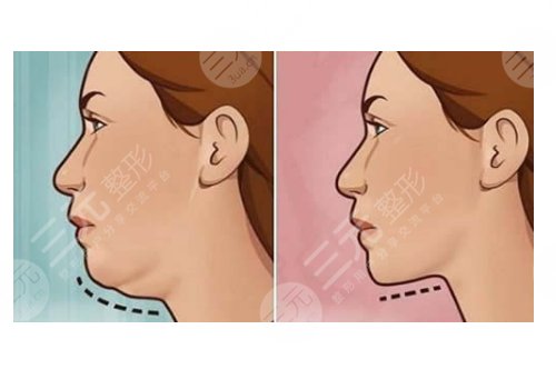 整容下巴需要花費(fèi)多少錢呢