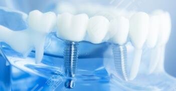 牙齒種植