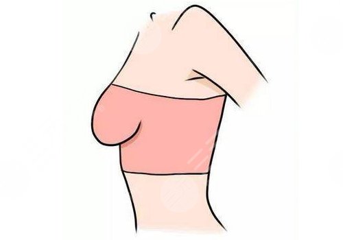 乳房下垂上提手術(shù)大約多少錢