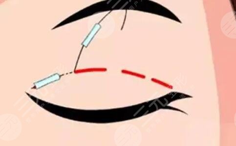 雙眼皮修復(fù)