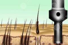 1000個(gè)毛囊面積圖片怎么樣？點(diǎn)擊查看價(jià)格標(biāo)準(zhǔn)和科普項(xiàng)目來了