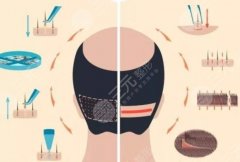 脫發(fā)1-7級(jí)程度圖片好不好？含有詳細(xì)的科普知識(shí)來啦