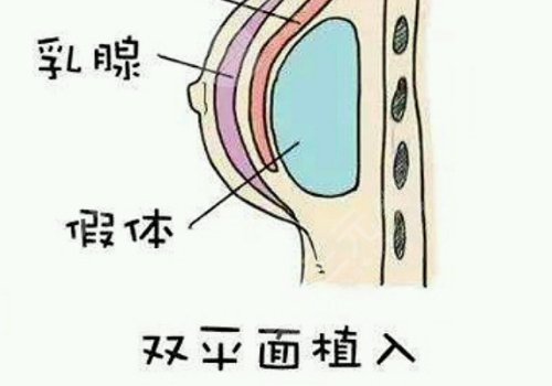 隆胸可以保持幾年
