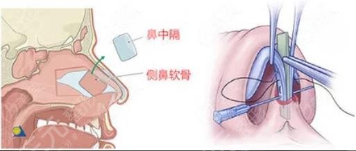 北京李勁良做鼻子價(jià)格?貴嗎