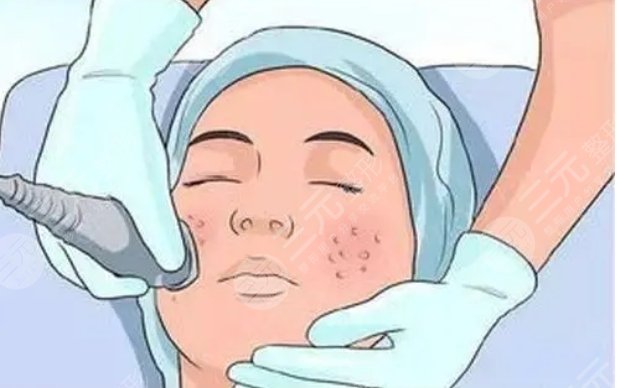 武漢同濟(jì)醫(yī)院激光祛斑案例