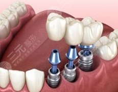 登騰種植牙有幾種價(jià)格？參考價(jià)格為4000元起，附種植牙信息一覽