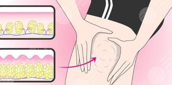 大腿吸脂