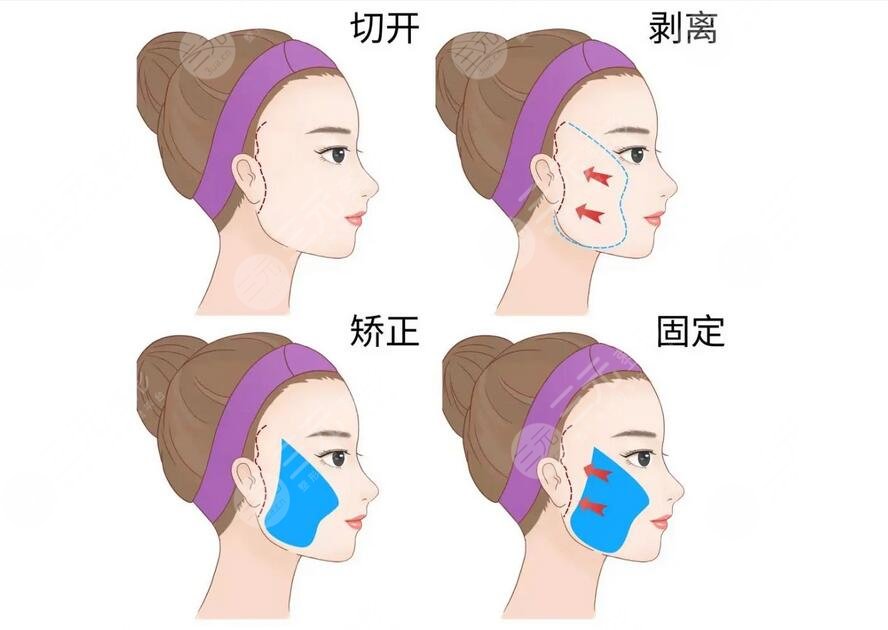 徐國建醫(yī)生拉皮手術(shù)費用是多少