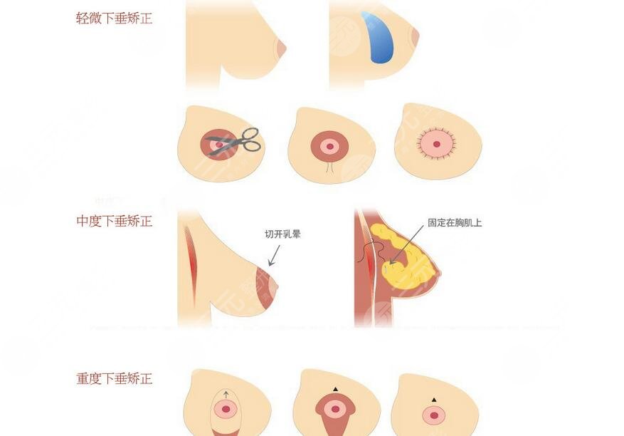 徐國建做胸部懸吊怎么樣