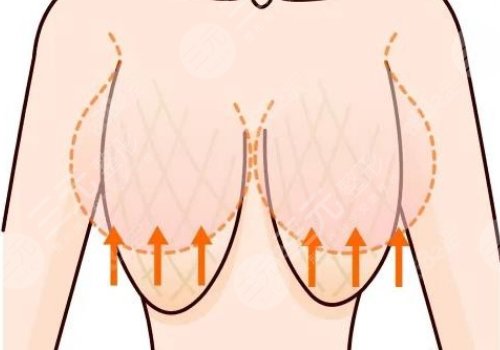 胸下垂外擴(kuò)有什么辦法能挺起來