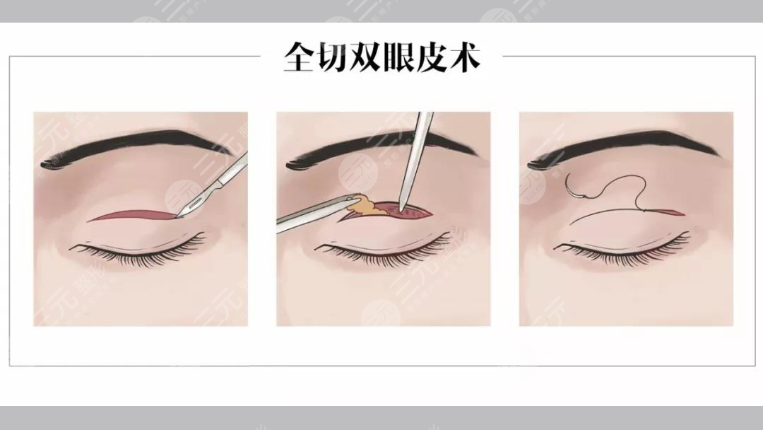 合肥李小靜雙眼皮案例分享！安醫(yī)附院整形實力派，醫(yī)生風(fēng)格揭秘~