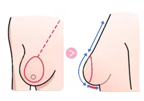 徐醫(yī)附院縮胸手術(shù)費(fèi)用