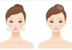 psv面部提升能維持多久？參考費用為1萬起