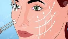 做拉皮手術(shù)能保持多少年？手術(shù)原理|費用|術(shù)后事項一覽