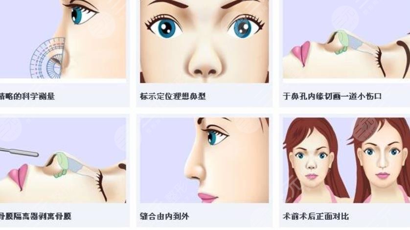 易陽(yáng)艷醫(yī)生鼻部整形案例