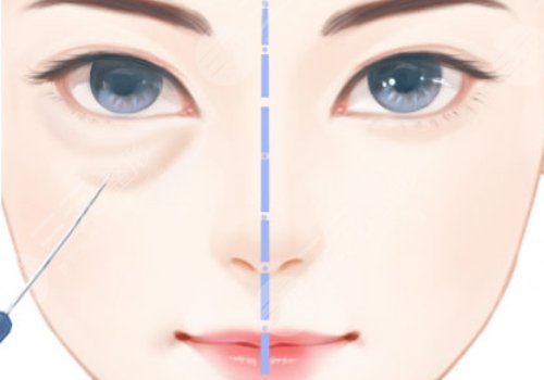 汕頭紫齡醫(yī)療美容門(mén)診部去眼袋多少錢(qián)