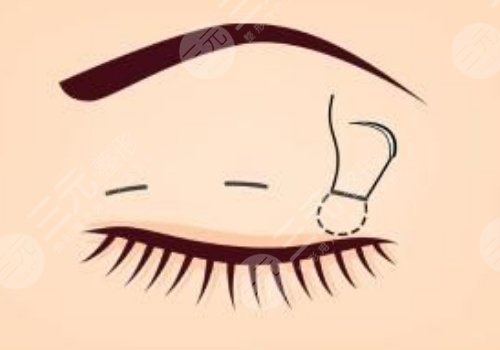 付冰川做雙眼皮多長時(shí)間了