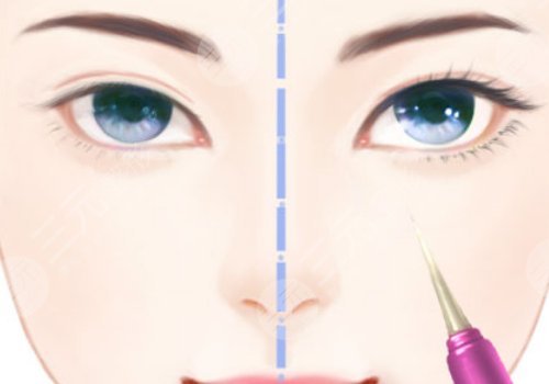 蘇州鄧哲雙眼皮