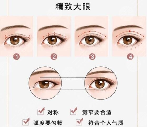 南方醫(yī)院陳若思案例分享！人氣整形醫(yī)生，雙眼皮術(shù)后點評~