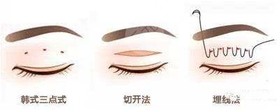 馬志兵醫(yī)生做雙眼皮如何？案例反饋，江蘇省中醫(yī)院熱門之選！