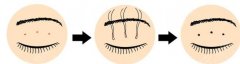 微創(chuàng)定點(diǎn)雙眼皮過(guò)程科普！美眼是這樣做成的，術(shù)前知識(shí)點(diǎn)掃盲~