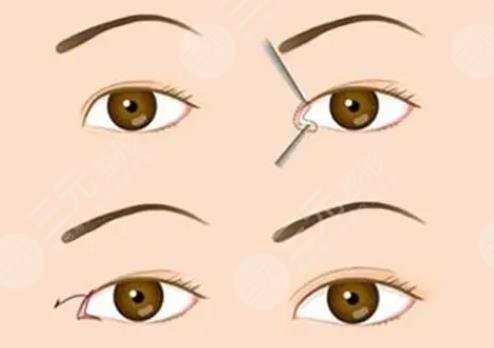 埋線雙眼皮