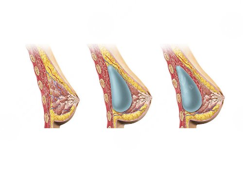 假體胸是什么材料做的