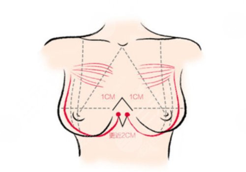 假體胸可以一輩子不取嗎