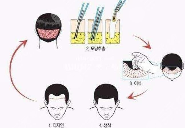 北京新生植發(fā)醫(yī)院發(fā)際線移植案例