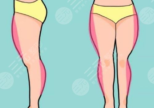 腿部吸脂手術(shù)多少錢(qián)