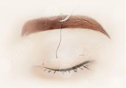 三眼皮迅速恢復(fù)雙眼皮