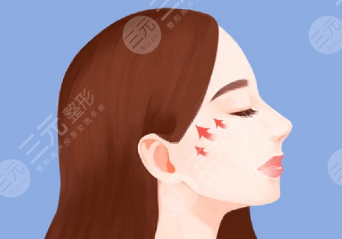 顴骨手術(shù)費用一般多少