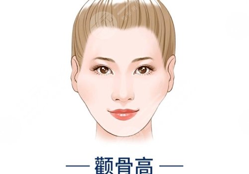 顴骨手術(shù)費用一般多少