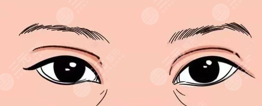 雙眼皮修復(fù)