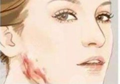 增生疤痕疙瘩怎么能徹底消除？祛疤修復(fù)指南，費用參考！