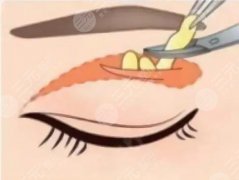 雙眼皮脂肪去多了凹陷怎樣修復？眼整形失敗，重塑指南！