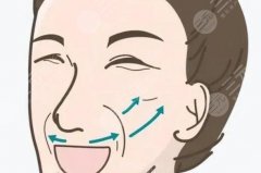 做拉皮手術(shù)能維持多久？40+面部除皺提升，科普分享！