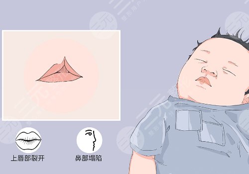 謝思田唇裂修復(fù)