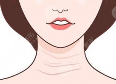 嗨體去頸紋對(duì)身體有害嗎？做嗨體去頸紋能保持多久