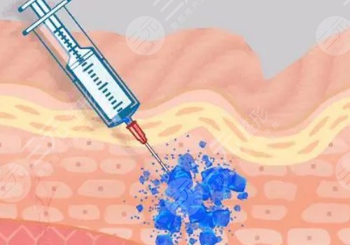 汕頭萊美醫(yī)療美容門診部玻尿酸怎么樣