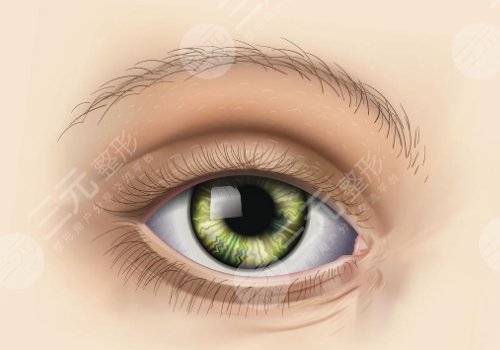 雙眼皮割寬了補救方法