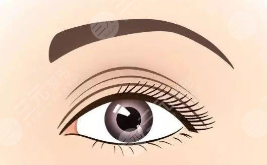雙眼皮修復