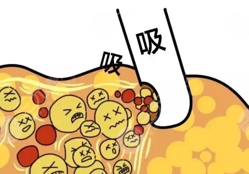 佛山曙光金子醫(yī)學(xué)美容醫(yī)院抽脂怎么樣